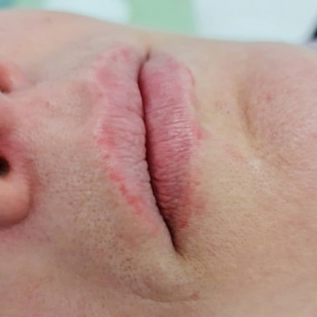 Лазерное удаление татуажа губ
                    Косметолог Мария Киев