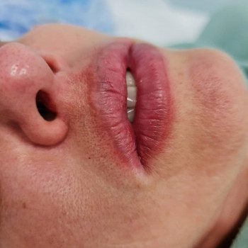 Лазерное удаление татуажа губ
                    Косметолог Мария Киев