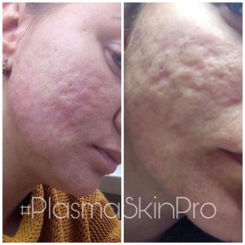 PlasmaSkin терапия ПОСТАКНЕ.
Результат остается на всегда!!