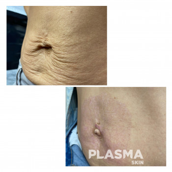 Устранение дряблости кожи после похудения. Шлифование холодной плазмой Plasmaskin