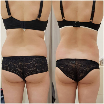 Антицеллюлитный массаж
                    Масажист Марина Одеса