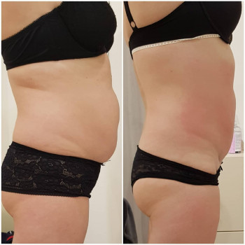 Антицеллюлитный массаж
                    Масажист Марина Одеса