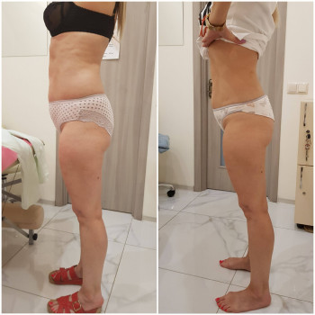 Антицеллюлитный массаж
                    Масажист Марина Одеса