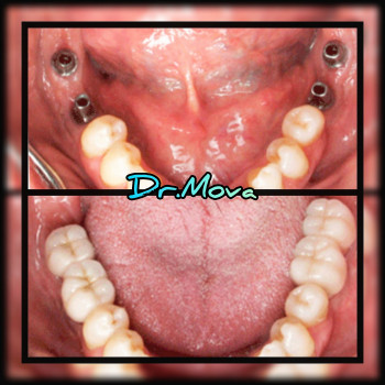 ИМПЛАНТАЦИЯ ЗУБОВ