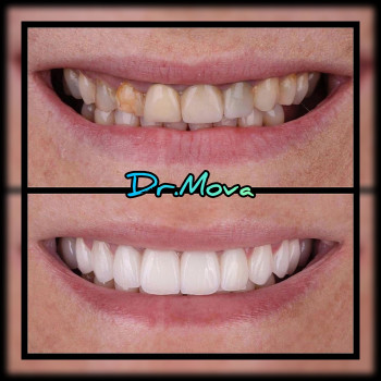 ЦИФРОВОЙ ДИЗАЙН УЛЫБКИ/ ВИНИРЫ /ЦИРКОНИЕВЫЕ КОРОНКИ