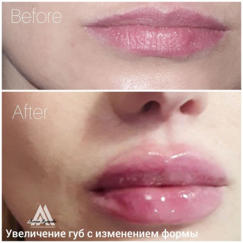 Заполнение обьема губ в технике "Бант" - "до" и "после" про