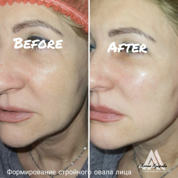 Коррекция средней трети лица и скуловой зоны