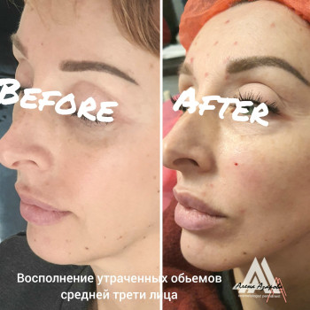 Контурная пластика скул
                    Косметолог Алена Харьков