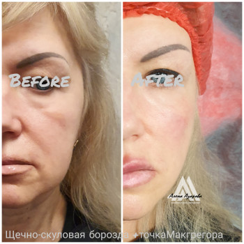 Коррекция средней трети лица и скуловой зоны.
