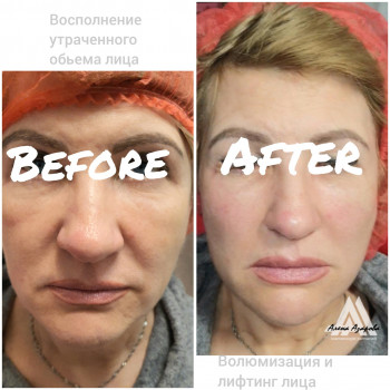 Контурная пластика лица
                    Косметолог Алена Харьков