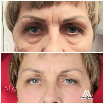 Липолиз малярных мешков и грыж в орбитальной зоне