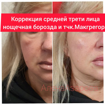 Контурная пластика скул
                    Косметолог Алена Харьков