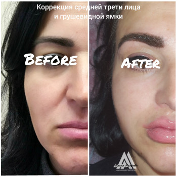 Контурная пластика лица
                    Косметолог Алена Харьков
