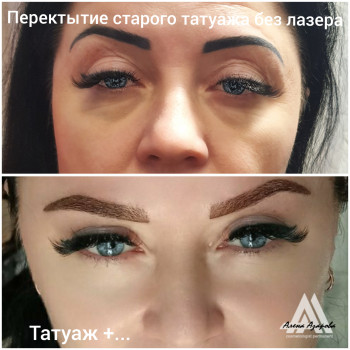 Заполнение носослезной борозды