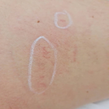 Удаление сосудов на лице и теле
                    Косметолог Мария Київ