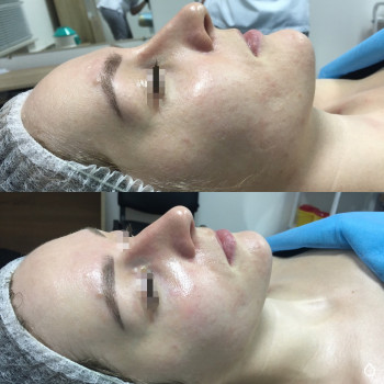 Карбокситерапия