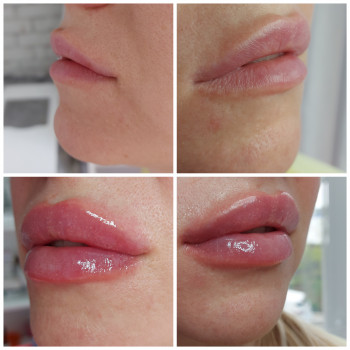 Увеличение губ