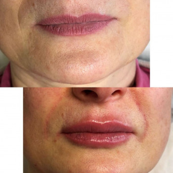 Контурная пластика(губки)