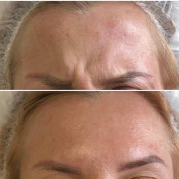 Инъекции ботулотоксина,межбровье