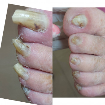 Робота з грибковим нігтем
                    Подолог Татьяна Викторовна Запорожье