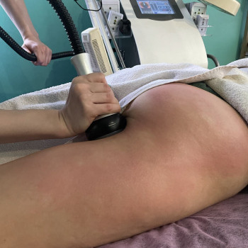 Вакуумный массаж+рф-лифтинг:
- убирает см
- подтягивает кожу