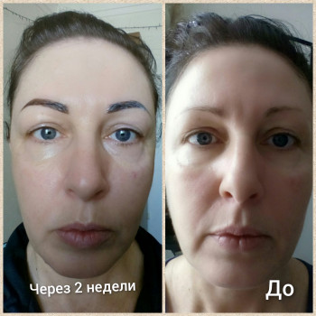 Биоревитализант с филлинговым эффектом(одна процедура 2800)