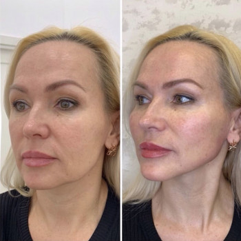 Коррекция подбородка,скуловой зоны,углов нижней челюсти.