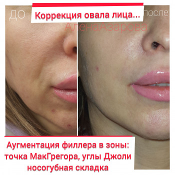 Заполнение носогубной складки
                    Косметолог Алена Харьков