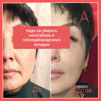 Заполнение носогубной складки
                    Косметолог Алена Харьков