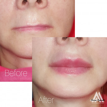 Коррекция прогении - западания губ в ротовую щель