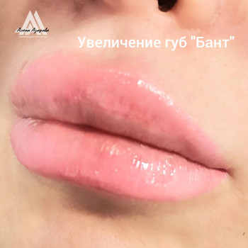 Волюмизация губ в технике "Плоский бант"