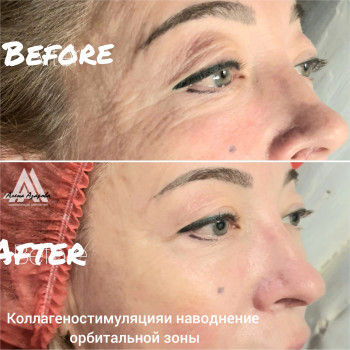 Заполнение морщин