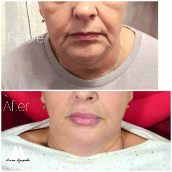 Векторное моделирование лица. Заполнение носогубной и губопо