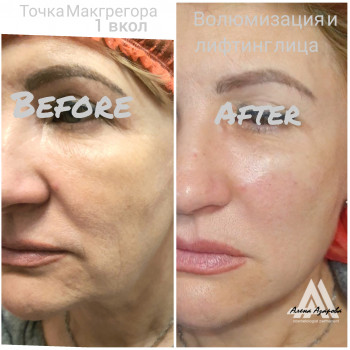 Векторное моделирование лица. Заполнение носогубной и губопо