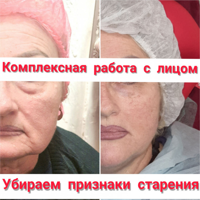 Векторное моделирование лица. Заполнение носогубной и губопо, фото - Косметолог Алена Азарова