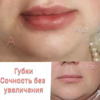 Увеличение губ "Naturelle"