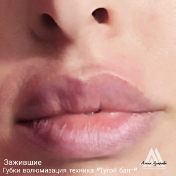 Заполнение обьема губ в технике зажившие губки