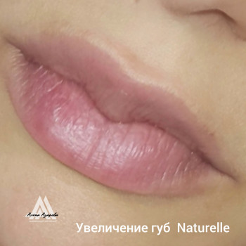 Увеличение губ "Naturelle"