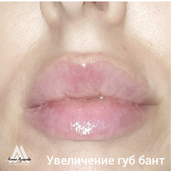 Заполнение обьема губ в технике "Бант"