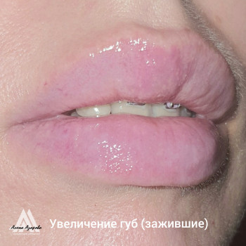 Заполнение обьема губ в технике "Бант"