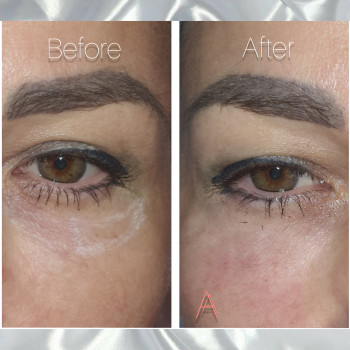 Один глаз(веко) -перед процедурой с разметкой, а на втором- 