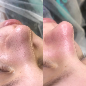 Чистка лица для подростков