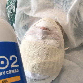 Карбокситерапия CO2