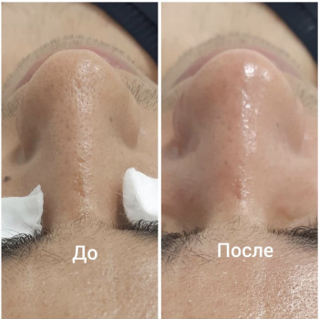 Чистка лица