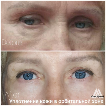 Мезоботокс