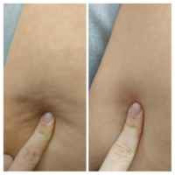 Антицеллюлитный массаж.