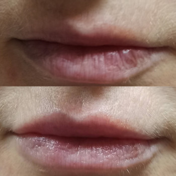 Коррекция возрастных губ