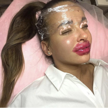 Збільшення губ нарощеннявій, фото - салон краси Sunkiss Beauty