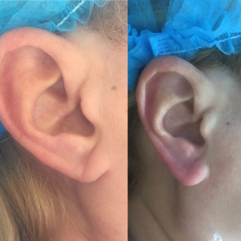 Заполнение филлером мочки уха