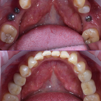 Імплантація, фото - стоматолог Вепа Джумаев